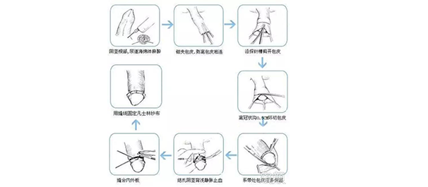 韶关割包皮，韶关割包皮费用，韶关割包皮费用多少